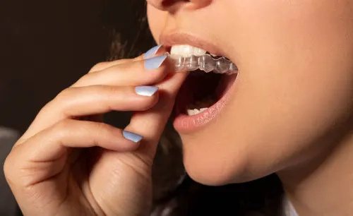 Clear Aligners & Orthodontics at Smiles for All Dental Clinic