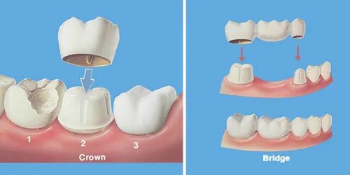 Crowns & Bridges at Smiles for All Dental Clinic