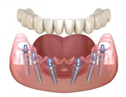 Implant-Supported Dentures treatment visual at Smiles for All Dental Clinic