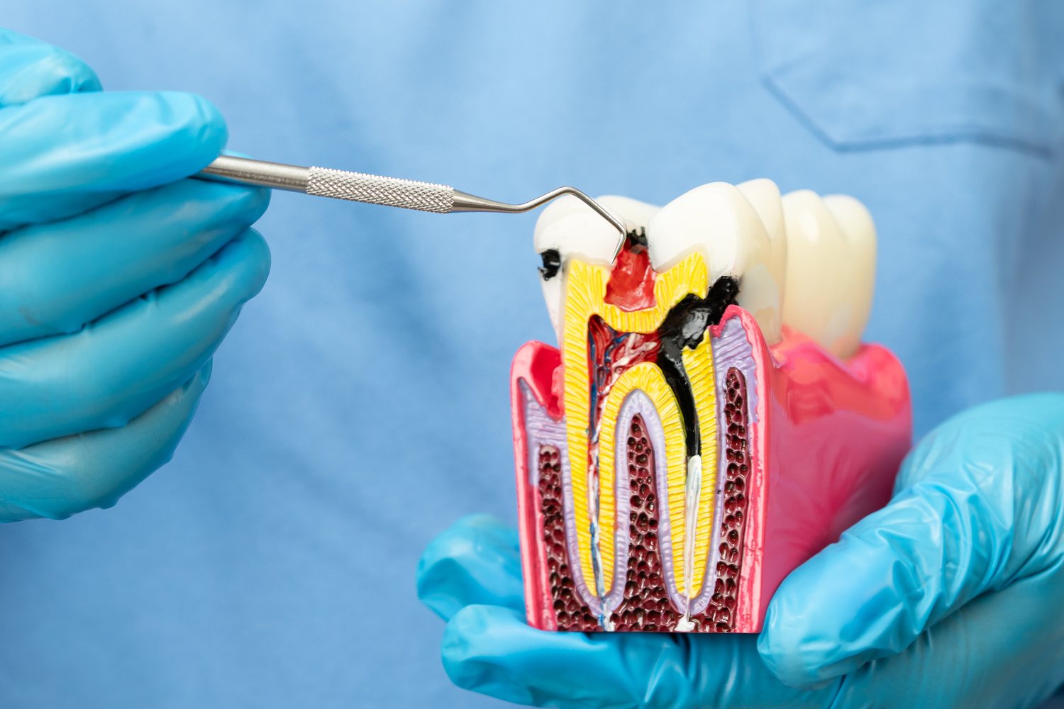 Root Canal Treatment at Smiles for All Dental Clinic