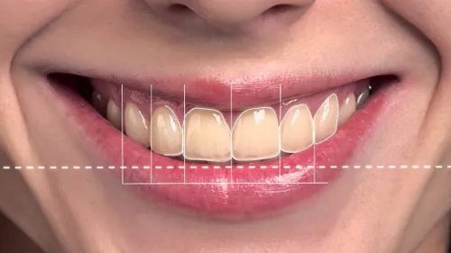 Smile Designing at Smiles for All Dental Clinic