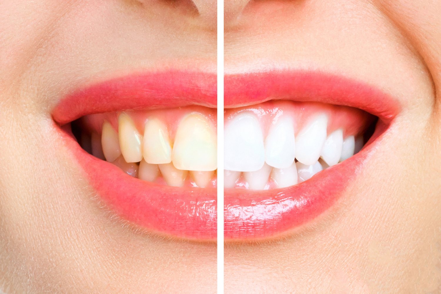 Teeth Whitening at Smiles for All Dental Clinic