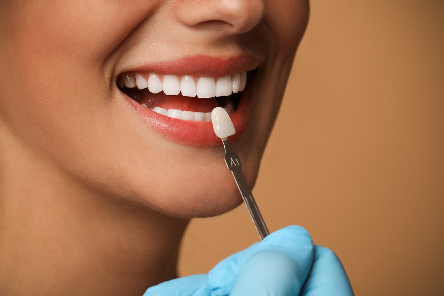 Veneers at Smiles for All Dental Clinic